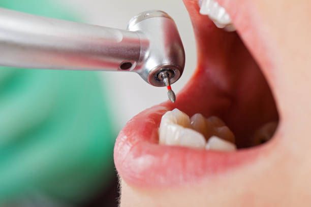 Best Emergency Treatment for Dental Infections or Abscesses in Craig, CO